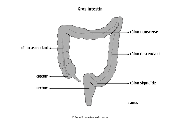 cancer colorectal