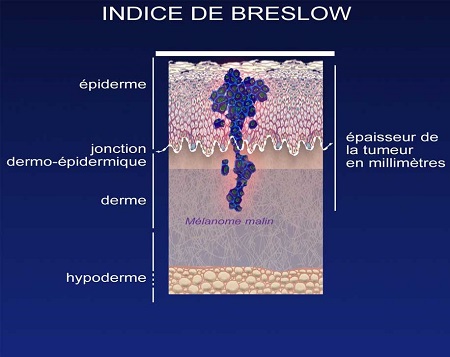 indice bresblow cancer peau