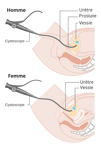 Cancer de la vessie - Diagnostic, symptomes | Urines dans le sang ...