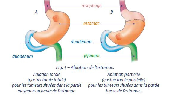 schema estomac