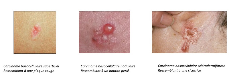 Cancer de la peau (mélanome, carcinome) - Diagnostic ...