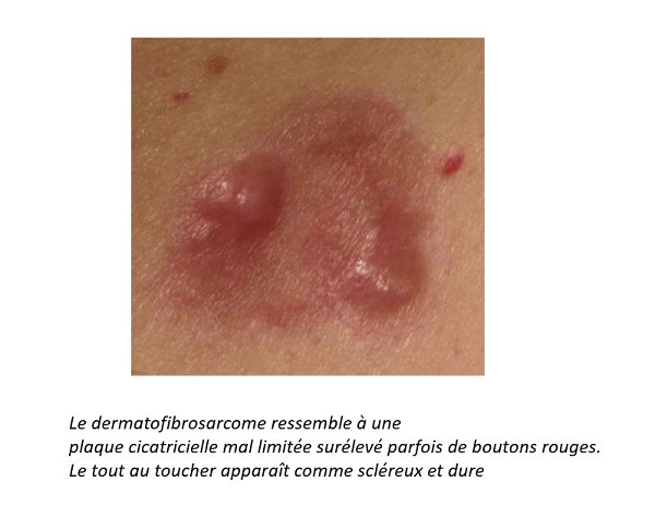 Cancer de la peau (mélanome, carcinome) - Diagnostic ...
