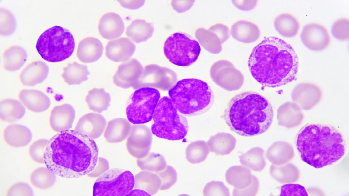 LMC leucémie myéloïde chronique