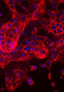 image cellules cancer du sein en 3 D