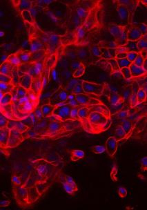 image cellules cancer du sein en 3 D