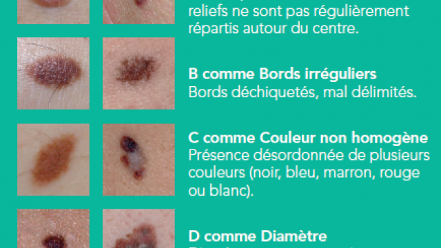 depistage-cancer-peau-methode-abcde
